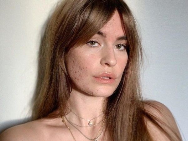 Decoding Facial Pimples: What Your Blemishes Say About&nbsp;You