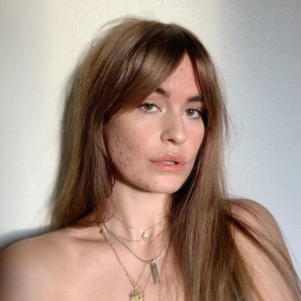 Decoding Facial Pimples: What Your Blemishes Say About&nbsp;You